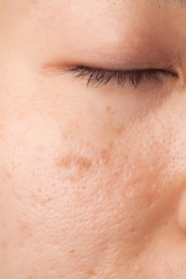 acne-scar skin - phasinphoto